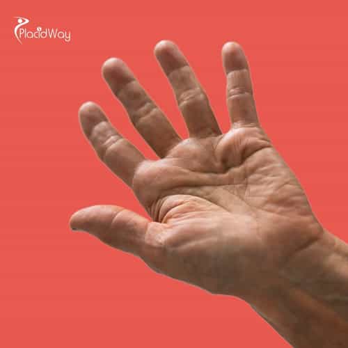 Guide for American Patients Seeking Tendon Injury Stem Cell Treatment in Mexico